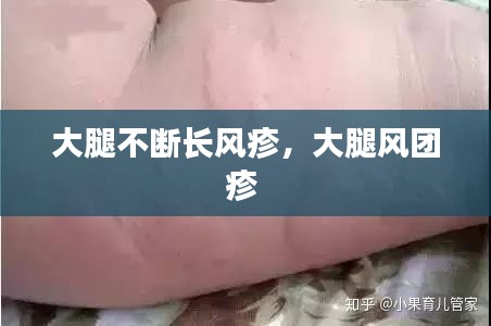 大腿不断长风疹，大腿风团疹 